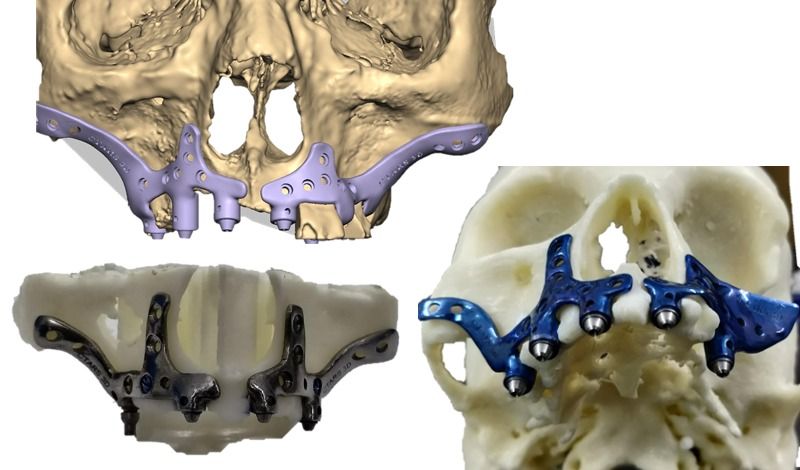 patient-specific-implant.jpg